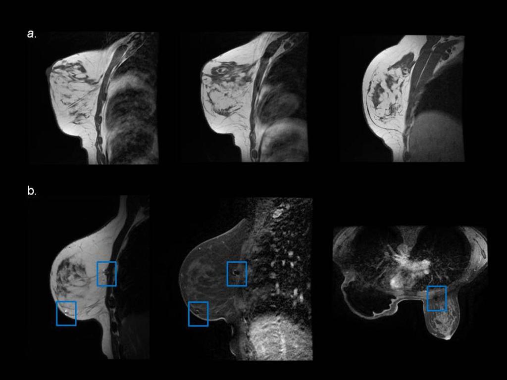 Fig. 6: Normal MRI postoperative findings after reduction mammoplasty.