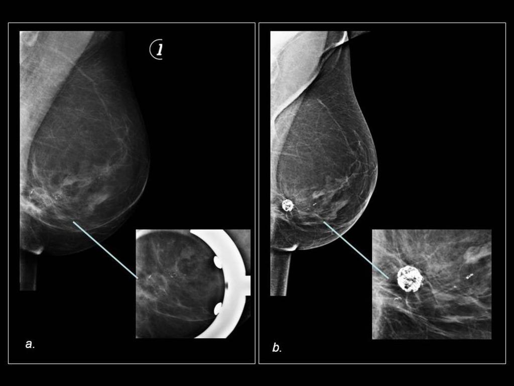 Fig. 8: 58-year-old woman with history of reduction mammoplasty (Wise pattern).