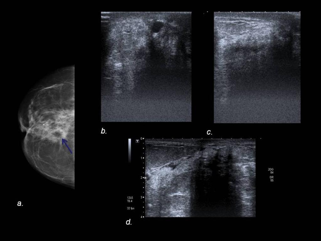 Fig. 10: Mammogram (a)reveals a right retroreolar focal asymmetry with radiolucenct density within it (arrow).