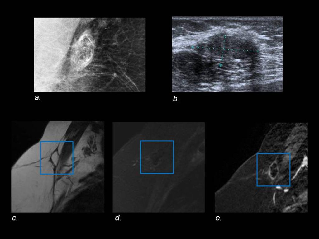 Fig. 12: Mediolateral oblique mammogram (a) shows a mass with lucent areas and stippled curvilinear and periph eral calcifications. US image (b) shows a well-marginated, solid hypoechoic mass.