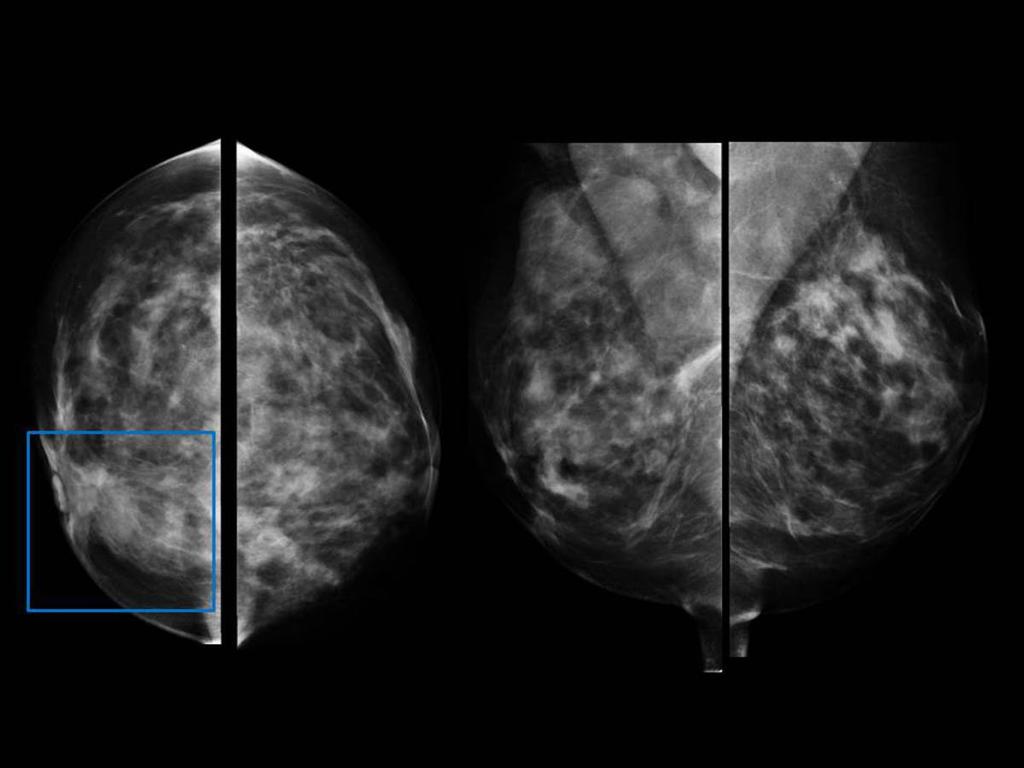 Fig. 13: 49-year-old woman with history of reduction mammoplasty who presented with a palpable retroareolar breast mass.