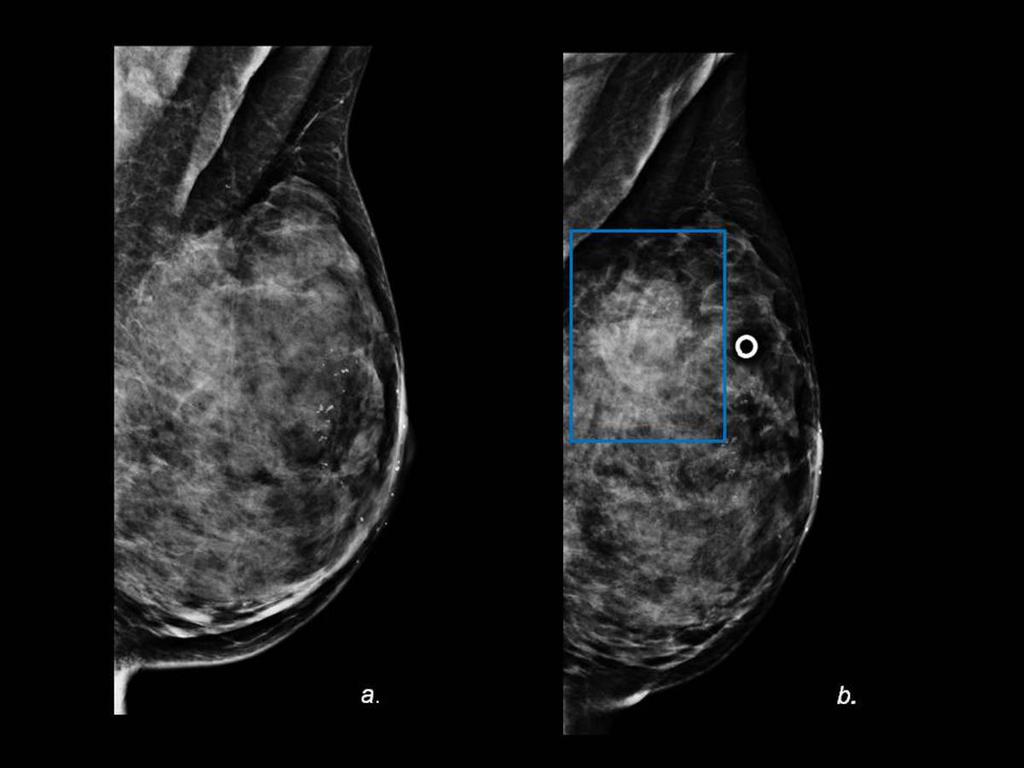 Fig. 15: (a) Mediolateral oblique mammogram of the left breast in a 41-year-old woman after reduction mammoplasty shows periareolar dermal calcifications and areolar thickening related to the