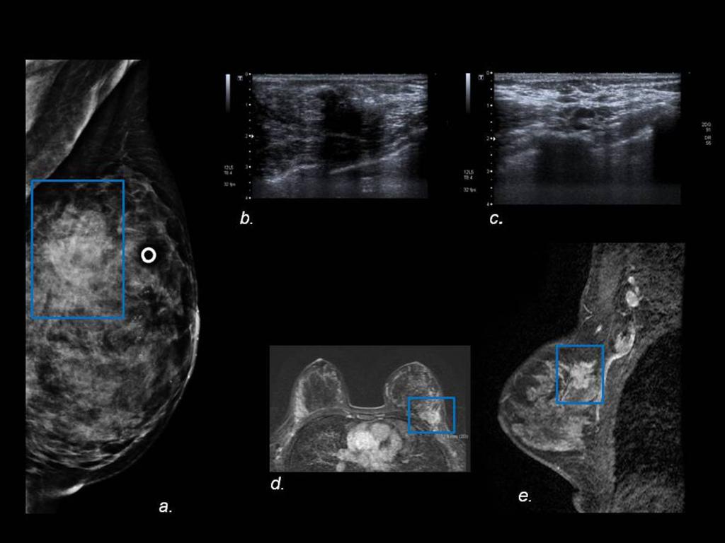 Fig. 16: (a)mediolateral oblique mammogram of the left breast shows an ill-defined mass (blue box) that was not present on previous mammograms.