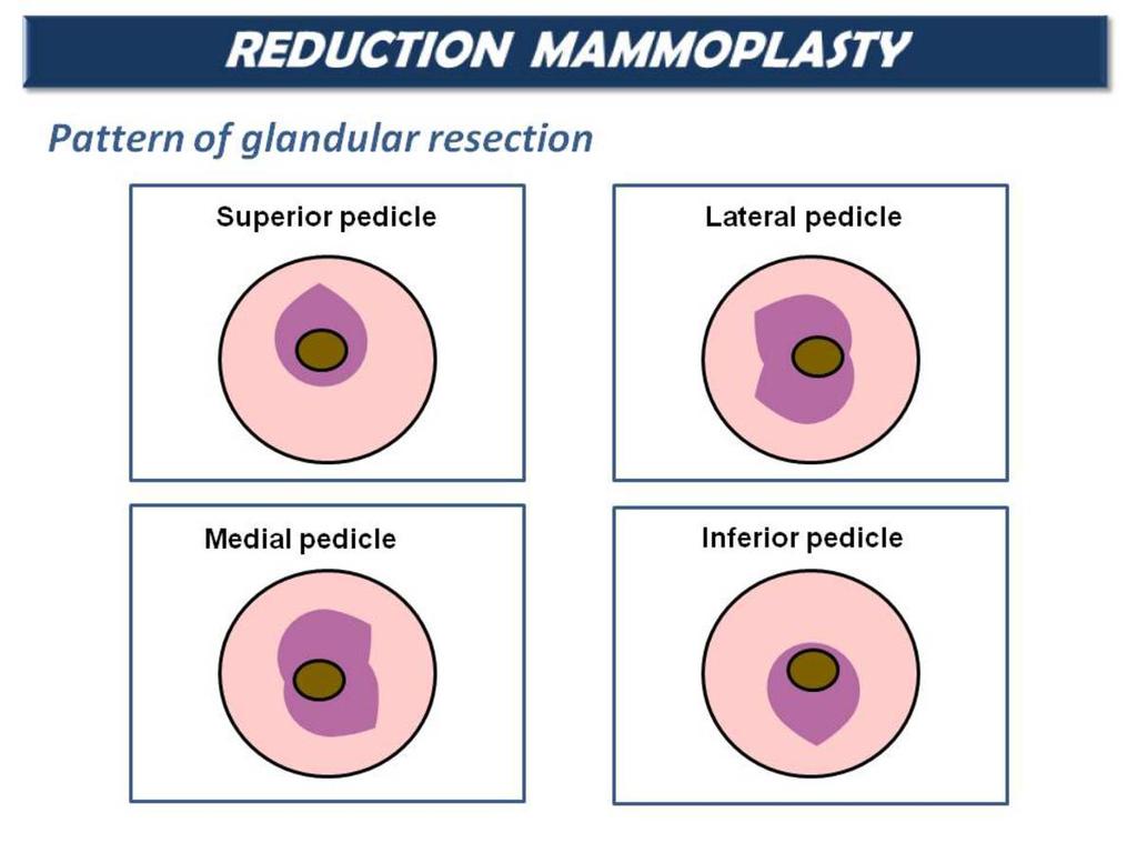 Fig. 2: Pattern of glandular resection.