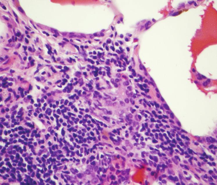 Renal biopsy revealed cellular crescent formation (e) and focal fibrinoid arteritis (f). Magnification 400 in (c) (f).