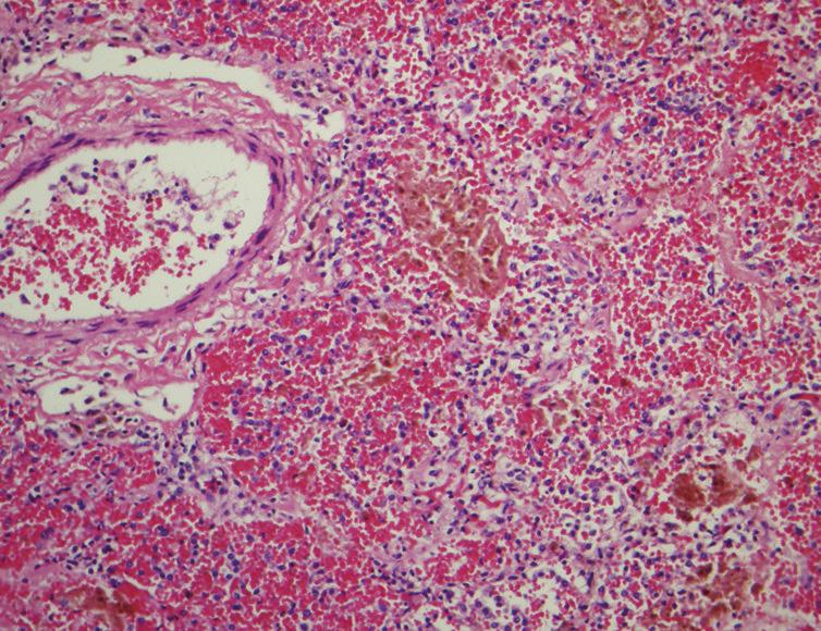 4 Case Reports in Pathology (a) (b) (c) (d) Figure 2: Goodpasture s syndrome in a 26-year-old woman. The patient presented with rapid progressive dyspnea over 2 weeks.