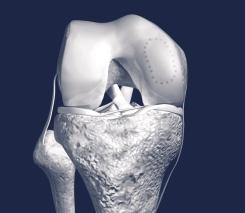 7 Left: (Ars Arthro AG) Damaged knee joint q Focal defect in the cartilage layer Middle: (Ars Arthro AG) Damaged knee joint q Punched out area prepared for transplantation plus the transplant adapted
