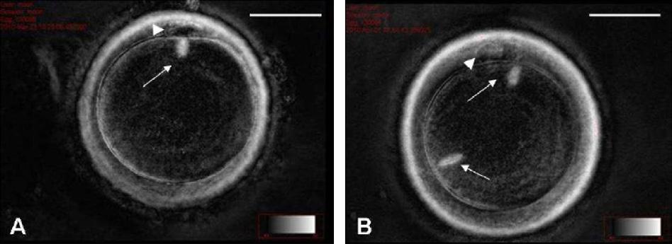 282 JH Moon et al. Figure 1 Unfertilized egg with one spindle (A) and two spindles (B) after failure of fertilization ( 400 magnification); arrows indicate spindles; arrow heads indicate polar bodies.