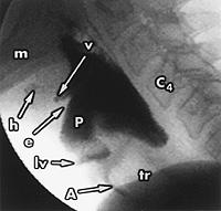 FIGURE 5. Lateral projection of the videoprint of a videographic swallowing study showing aspiration of liquid barium.