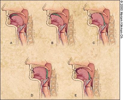 FIGURE 2. Lateral view of the oral propulsive phase of swallowing chewed solid food in a normal person, based on videofluorographic recordings.
