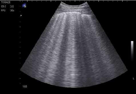Point-of-Care Ultrasound: Holistic Approach Pre-test probability (history & exam) Ultrasound Heart Chamber size & function Lung B-lines IVC Tolerance Post-test probability (Volume: yes/no) Bedside
