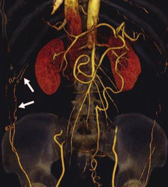 rcs fuse with fusion of aorta and eventually form three trunks namely celiac, superior mesenteric artery (SM), and inferior mesenteric artery (IM). rteries shift caudal with development of fetus.