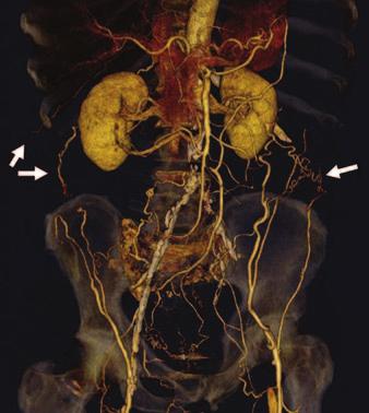 Inferiorly, lumbar arteries communicate with external iliac artery via deep circumflex iliac artery [2].