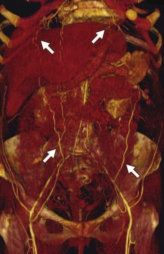 Hardman et al. Fig. 6 Systemic-systemic obturator artery collateral in 77-year-old man. Various arterial pathways can transverse pelvis.