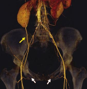 rterial branches are seen from internal iliac artery, external iliac artery, and common femoral artery.