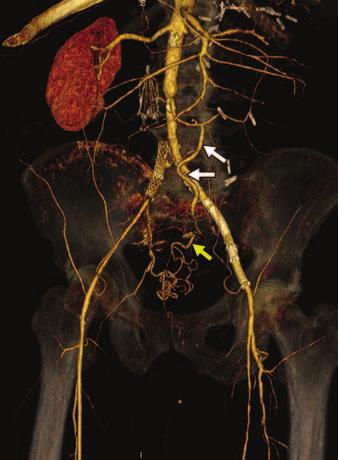 Collateral Pathways in ortoiliac Occlusive Disease Fig. 7 Visceral-visceral and visceral-systemic inferior mesenteric artery (IM) collateral pathways in 62-year-old man.