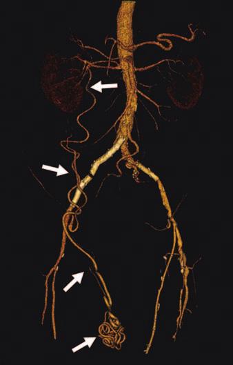 Occlusion of superior mesenteric artery or celiac trunk with patent IM will show flow from IM through left colic artery and through pathway such as meandering mesenteric artery.
