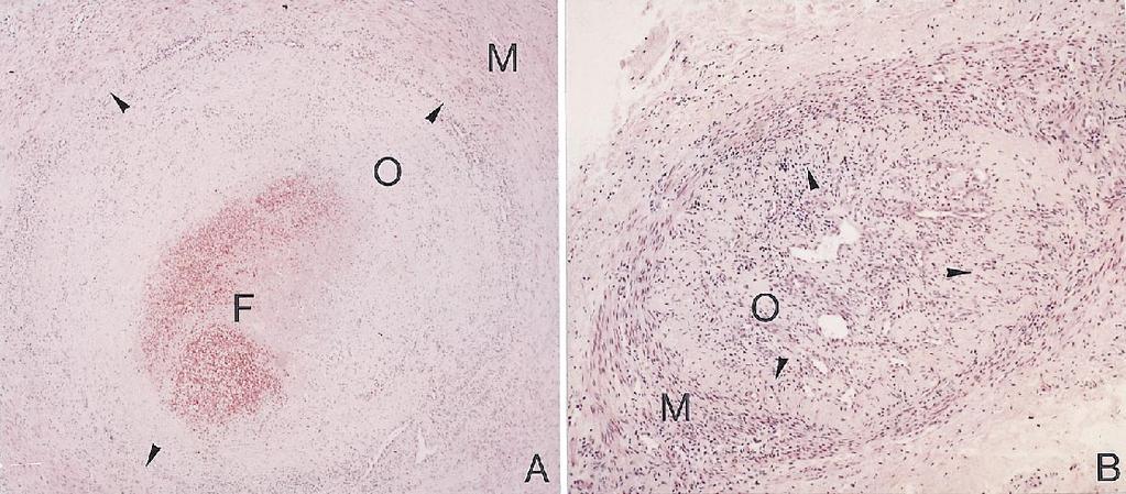 Volume 29, Number 3 Kobayashi et al 453 Fig 2. Photograph of subacute stage lesion (A) and chronic stage lesion (B). In the subacute lesion, fresh thrombi and organized thrombi are seen.