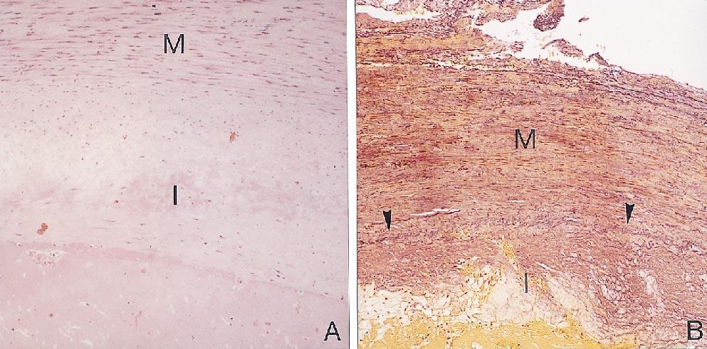 456 Kobayashi et al March 1999 Fig 6. Photograph of atherosclerotic control cases. Fibrointimal proliferation and hyaline degeneration were seen (I). Foam cells were seen in the proliferated intima.