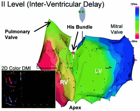 Inter-Ventricular Delay LV is