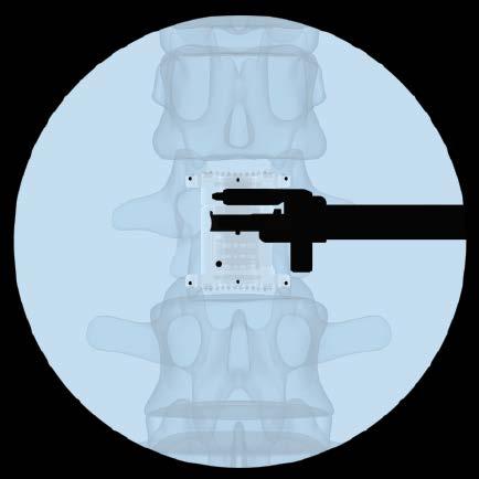 Verify the position of the implant using the image intensifier.