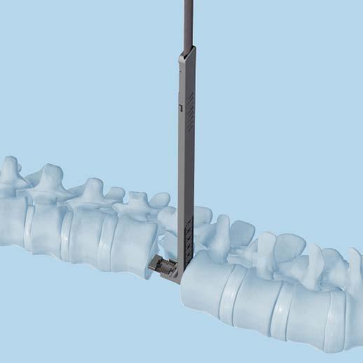 insert trial implant the XRL Vertebral body Replacement contains a complete line of central body and endplate