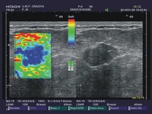 Additional Screening with Whole breast US Is elastography important- yes What