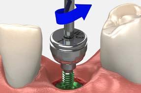 The abutment has Laser-Lok microchannels for connective tissue attachment and is TiN coated for esthetics.