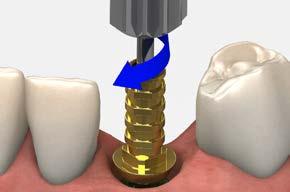 Use this technique at the time of implant placement, implant uncovery or when a Laser-Lok healing abutment has been used to establish and
