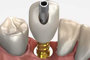 Place the modified Easy Ti temp abutment onto the implant using the abutment screw and an.050 (1.25mm) hex driver. Hand tighten.