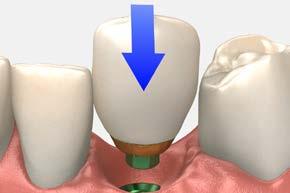 Replace the healing abutment immediately to prevent soft tissue collapse over the implant.