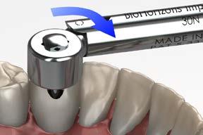 temporary restorations screw-retained crown using the Laser-Lok Easy Ti temp abutment 10 Check and modify occlusion Check the occlusion and contacts.