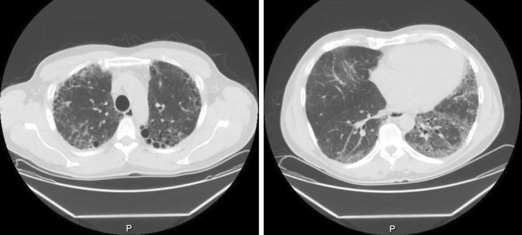 BID twice daily, CT computed tomography, PO oral Repeat pulmonary function testing and CT imaging (Fig. 2) demonstrated a slowing of the progression of disease, but notable subtle worsening.