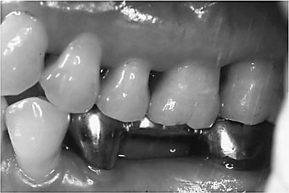 Maintenance therapy plays an important role in the longevity of teeth. In patients without maintenance, there is an increased risk of tooth loss 18).