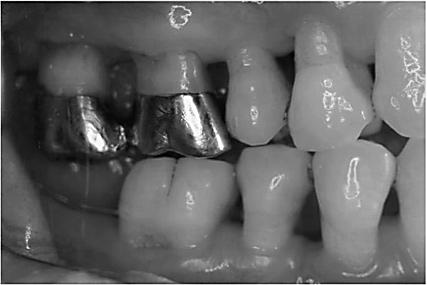trauma during SPT. Further occlusal adjustment was performed, when indicated.