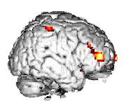 The prefrontal response in schizophrenia is abnormal: Either too