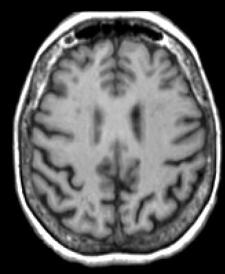 Functional imaging findings 4. +/- neuropathology Hippocampus 1.