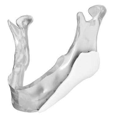 The host bone model is provided as a preoperative guide to demonstrate orientation and fit of