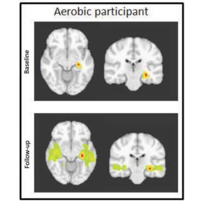 Hippocampus: Exercise, Cognition, and Brain in MS Aerobic exercise related improvements in learning and memory 10,30,31, hippocampal volume,