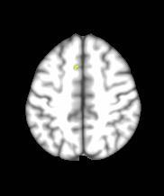 regions (i.e., superior frontal gyrus,