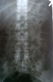 Postoperative X-rays - L4S1 fusion with L4-5 interbody titanium cage. ase 2 A 57 years old female (patient No.