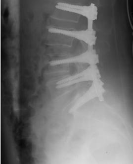 An incomplete iatrogenic dural tear led to the formation of a pseudomeningocele and a SF fistula which closed