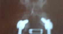 Anteroposterior X-ray shows a reducible right scoliotic deformity of the lumbar spine with no rotational
