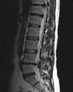 oedema adjacent to L4-5 vertebral end-plates.