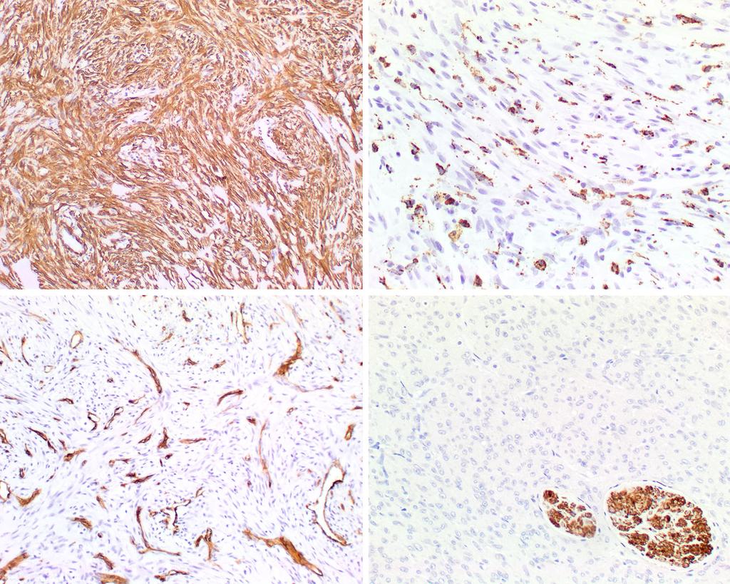 9 The lesion cells showed the following immunohistochemistry results: Left upper smooth muscle actin positive.