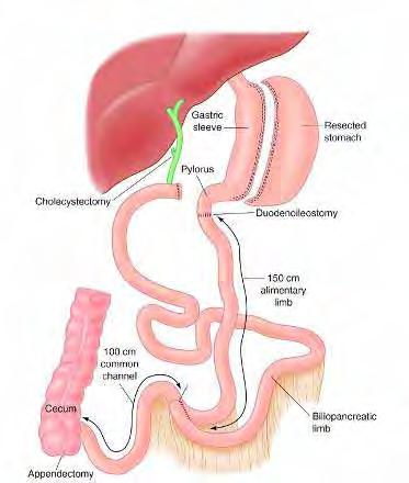 History of Bariatric Surgery Duodenal switch introduced by Marceau Lesser curvature gastric tube Vertical resection of 2/3 of the
