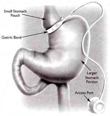 History of Bariatric Surgery Restrictive procedures 1993: