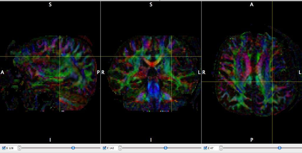 Diffusion MR Tractography has recently emerged as potentially valuable clinical tool for presurgical planning(7-9) and intraoperative imaging- guided navigation in the operating room(10).