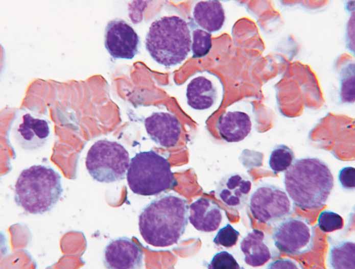 A B C D Images 1A, 1B, 1C, and 1D A, The bone marrow aspirate smear shows marked