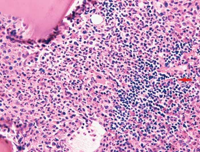 B, The decalcified bone biopsy shows a small cluster of lymphocytes identified by